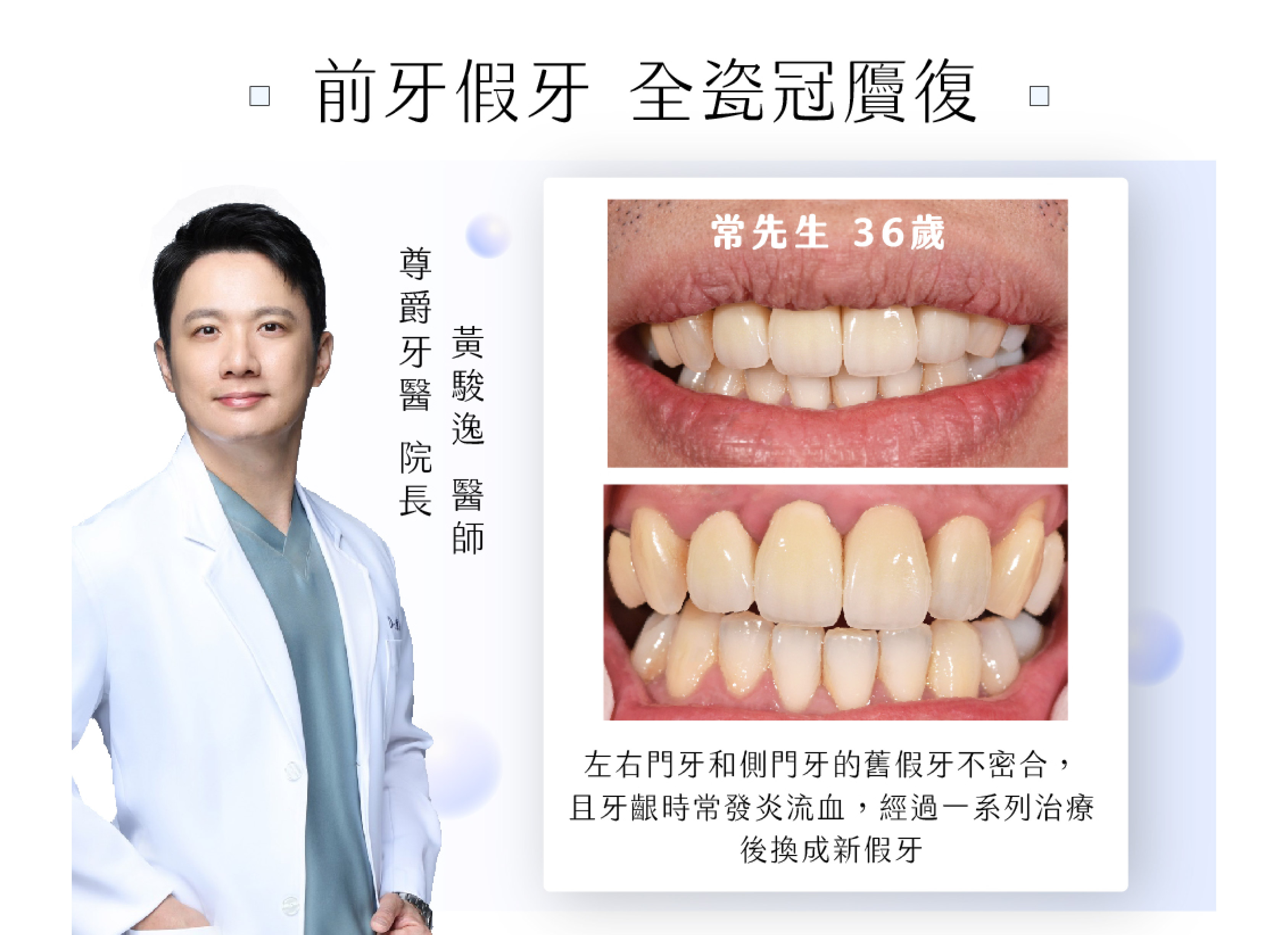 尊爵牙醫院長-黃駿逸醫師分享：前牙假牙 全瓷冠贗復 
