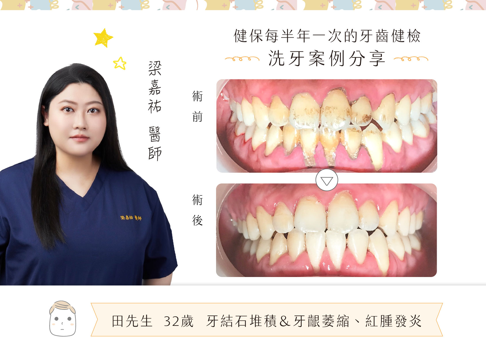 梁嘉祐醫師-案例分享 ❙ 牙齒健康防禦術-洗 牙 